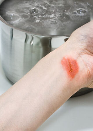 Woman’s,Hand,With,Injuries,Near,The,Pot,With,Boiling,Water,